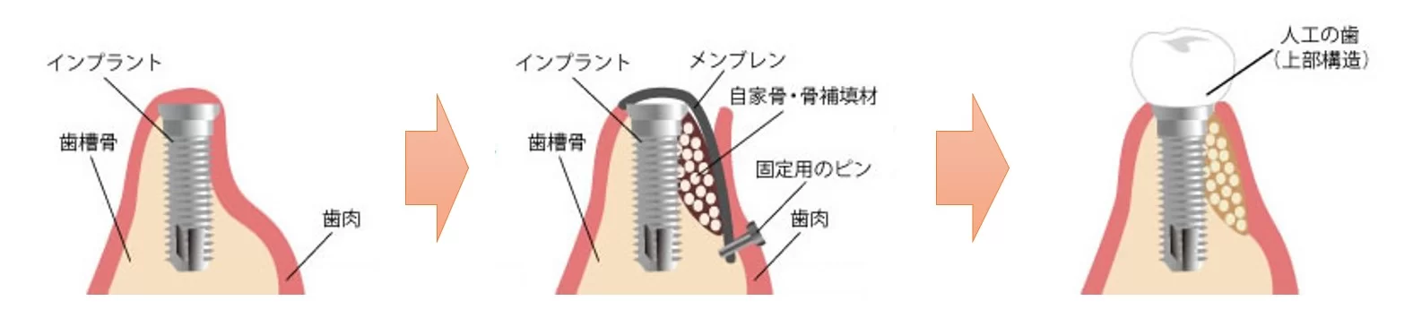 元住吉（川崎市）の歯医者でGBR法によるインプラント治療