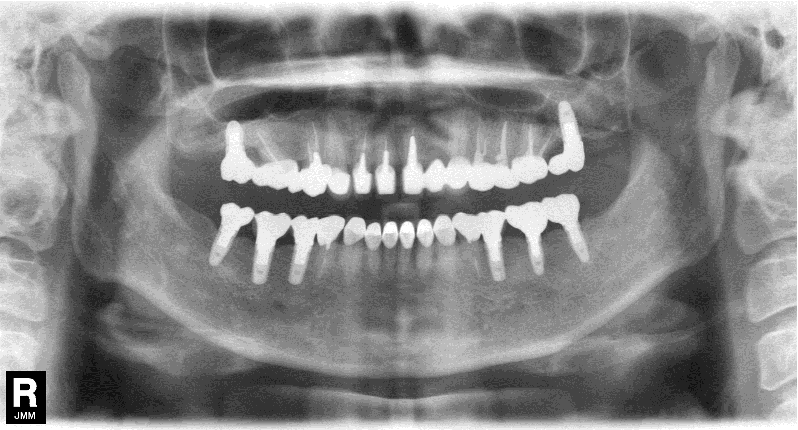 元住吉の歯医者のインプラント治療症例