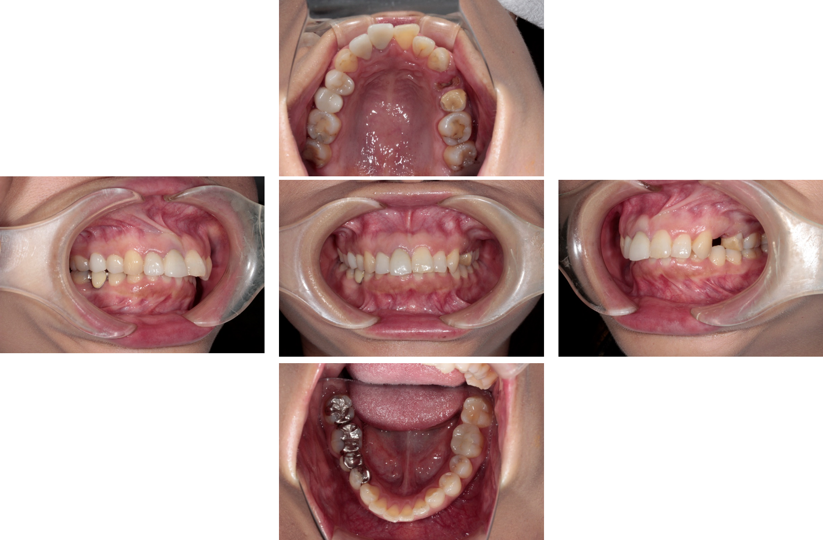 元住吉の歯医者のインプラント治療症例