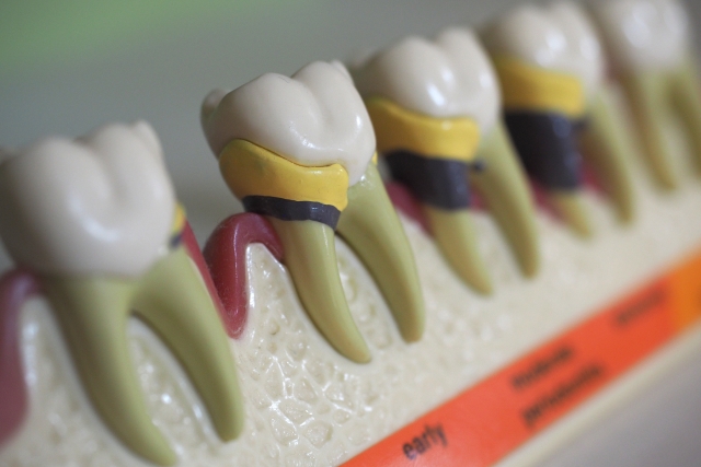 元住吉（川崎市）の歯医者でインプラント治療のリスク紹介