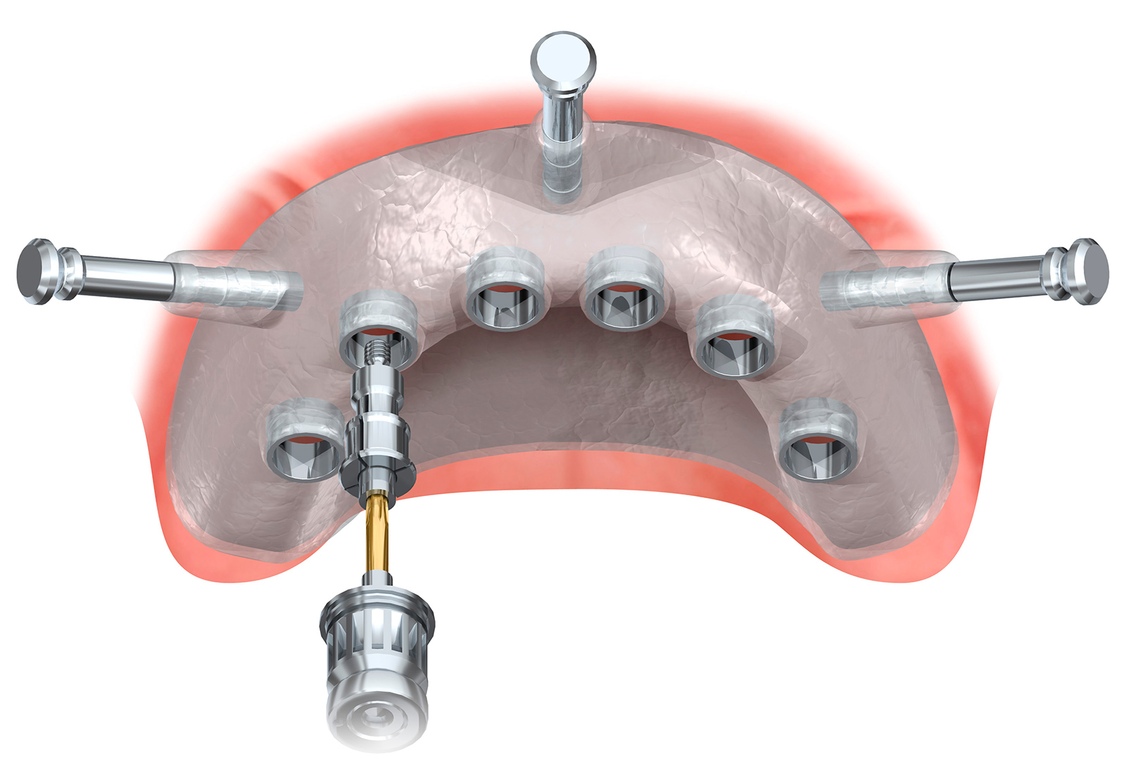 フラップレスインプラント - 元住吉（川崎市中原区）でインプラント